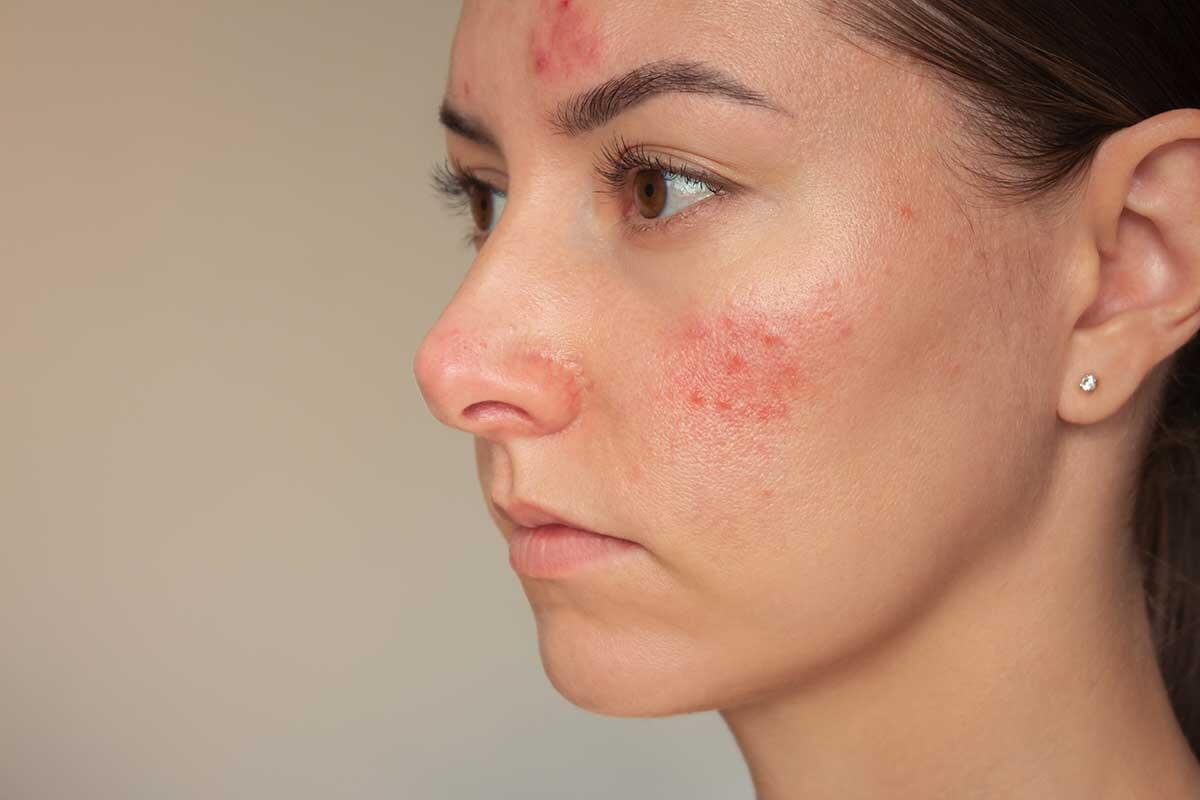 Rosacea: Penyebab, Gejala, dan Pengobatan yang Efektif