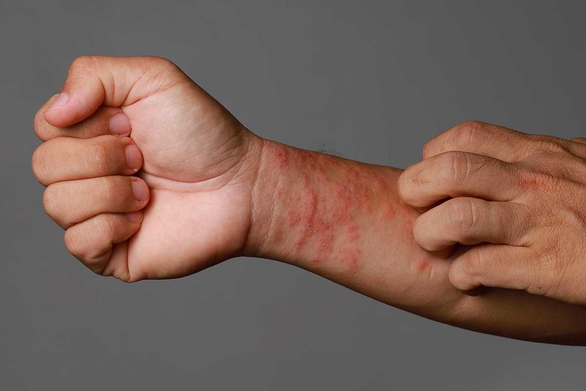 Eczema: Gejala, Penyebab, dan Pengobatan yang Efektif