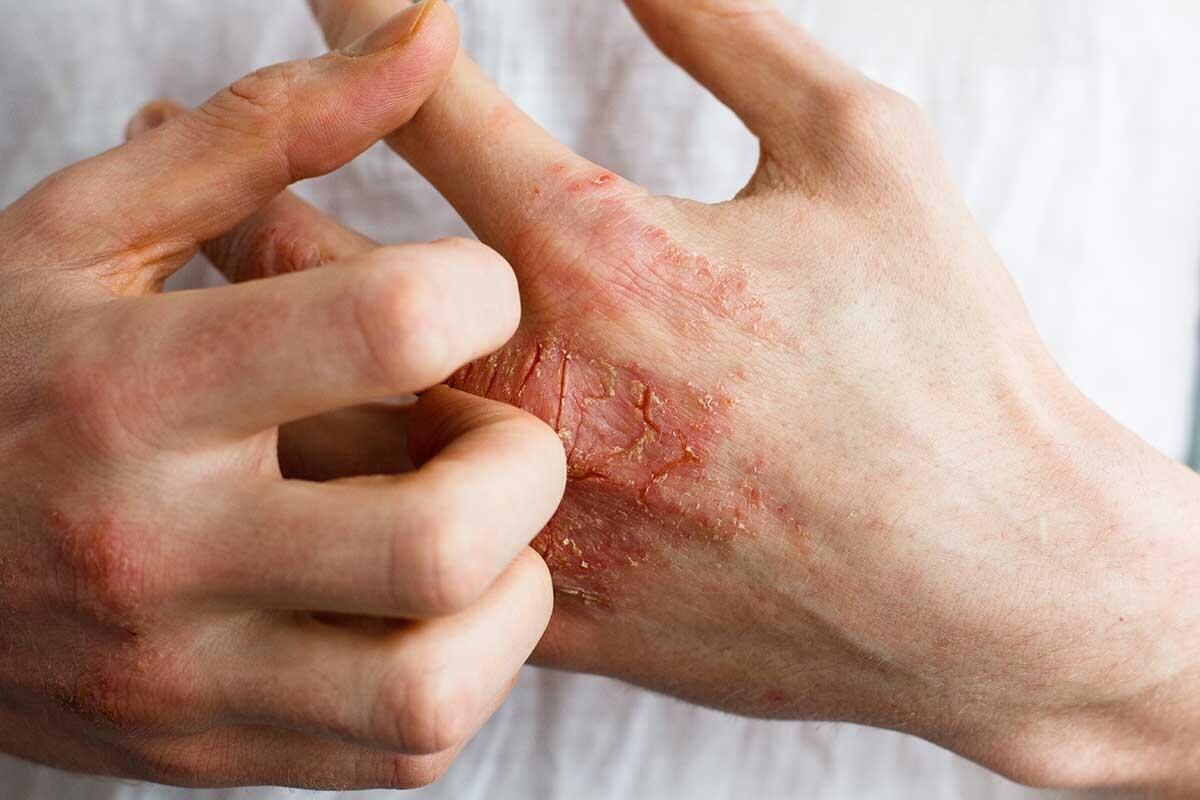 Dermatitis: Memahami Dermatitis Kontak dan Dermatitis Atopik